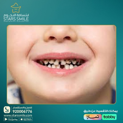 نصائح للعناية بأسنان الأطفال