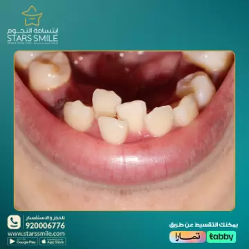 تزاحم الاسنان