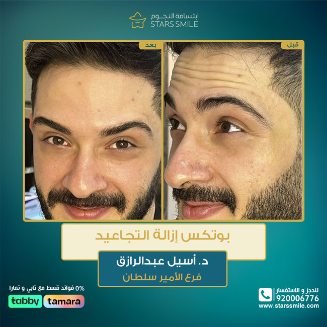 <p style="text-align:right"><span style="font-size:26px"><strong><a href="https://www.starssmile.com/offers/dermatology"><span style="color:#1abc9c">بوتكس </span></a>ازالة التجاعيد&nbsp;</strong></span></p>

<p style="text-align:right"><span style="font-size:26px"><strong>فرع الامير سلطان&nbsp;</strong></span></p>

<p style="text-align:right"><a href="https://www.starssmile.com/doctors/dermatology/Dr.-Aseel-Abdel-Razek"><span style="color:#1abc9c"><span style="font-size:26px"><strong>د/اسيل عبدالرازق&nbsp;</strong></span></span></a></p>