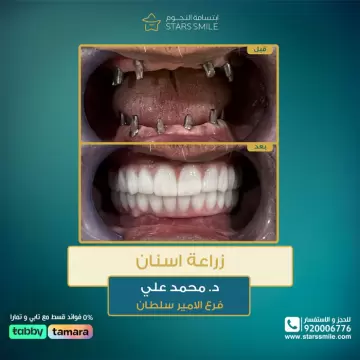 <p style="text-align:right"><a href="https://www.starssmile.com/offers/dental?page=2"><span style="color:#1abc9c"><span style="font-size:26px">زراعة اسنان&nbsp;</span></span></a></p><p style="text-align:right"><a href="https://www.starssmile.com/doctors/dental/Dr-Muhammad-Ali"><span style="color:#1abc9c"><span style="font-size:26px">د/ محمد على&nbsp;</span></span></a></p><p style="text-align:right"><span style="font-size:26px">فرع الامير سلطان</span></p>