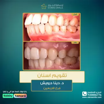 <p style="text-align:right"><a href="https://www.starssmile.com/offers/dental"><span style="color:#1abc9c"><span style="font-size:26px">تقويم الاسنان&nbsp;</span></span></a></p><p style="text-align:right"><a href="http://www.starssmile.com/doctors/dental/Dr.-Dina-Darwish"><span style="color:#1abc9c"><span style="font-size:26px">د/دينا درويش&nbsp;</span></span></a></p><p style="text-align:right"><span style="font-size:26px">فرع الاربعين</span></p>